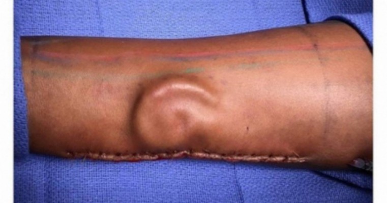 Bizarro: Médicos criam orelha em braço de mulher
