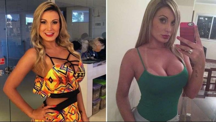 Caso Andressa Urach: entenda o que é o hidrogel e os riscos do procedimento