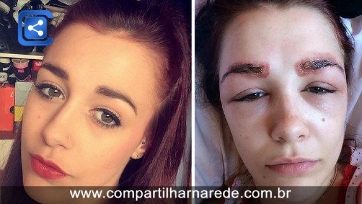 ALERGIA À MICROPIGMENTAÇÃO QUASE FAZ GAROTA PERDER SOBRANCELHAS