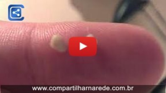 O que são aquelas bolinhas amarelas fedidas que saem da garganta 
