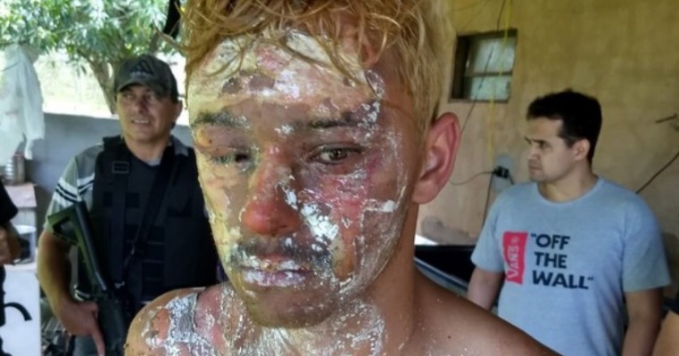 Grávida queima rosto do ex após ser raptada e estuprada por ele