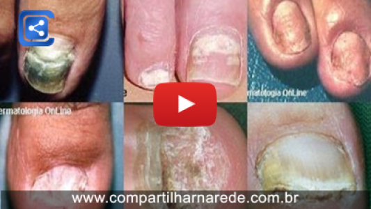 Receita Caseira para Micose nas Unhas 