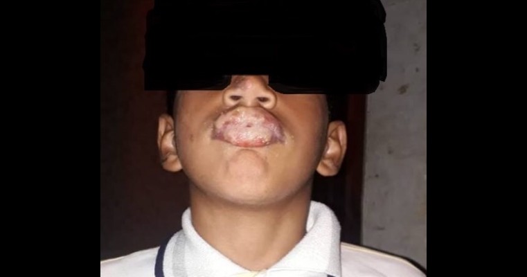 Salgueiro - Criança 06 anos foi vítima de maus tratos e tem lábios queimado por mãe adotiva