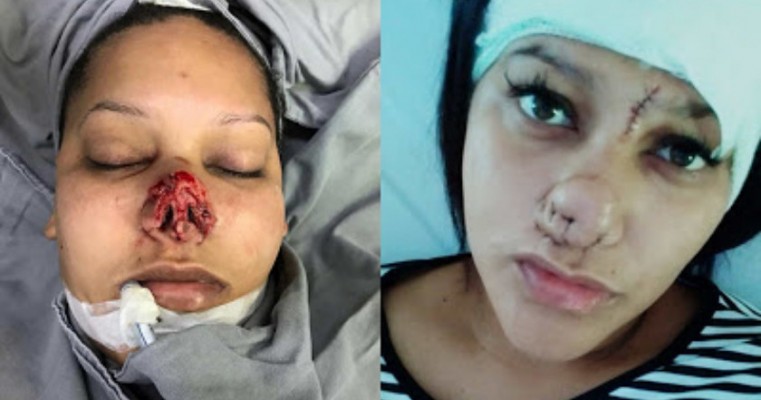 Mulher que teve nariz arrancado pelo ex terá de fazer 15 cirurgias