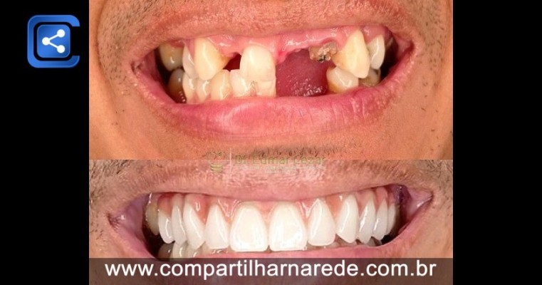 Implante Dentário Antes e Depois em Salgueiro PE Dr Edmar Cezar