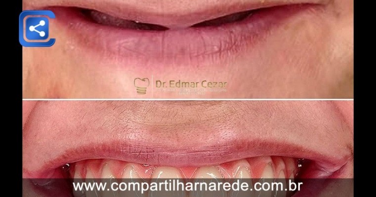 Implante Dentário barato em Salgueiro PE Dr Edmar Cezar