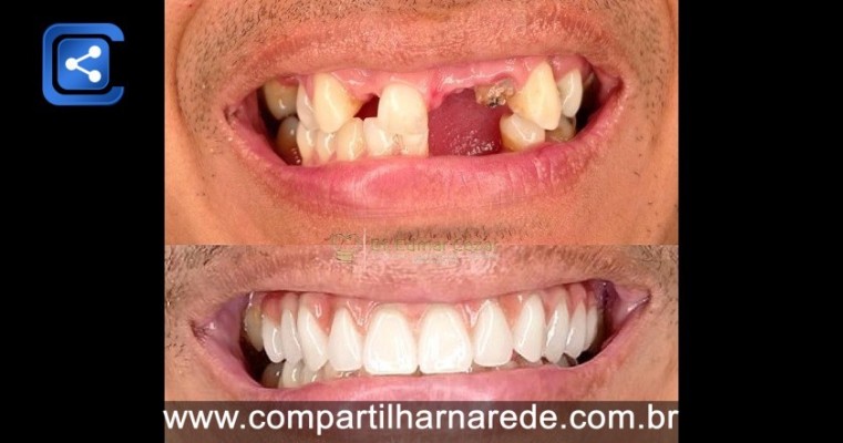 Implante Dentário benefícios em Salgueiro PE Dr Edmar Cezar