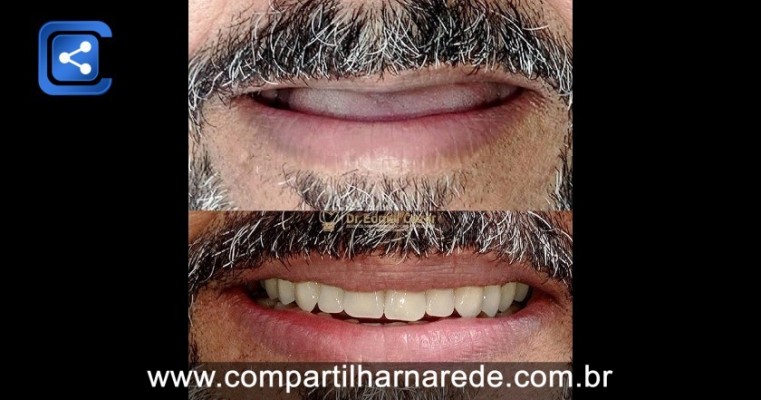 Prótese dentária fixa em Salgueiro PE Dr Edmar Cezar