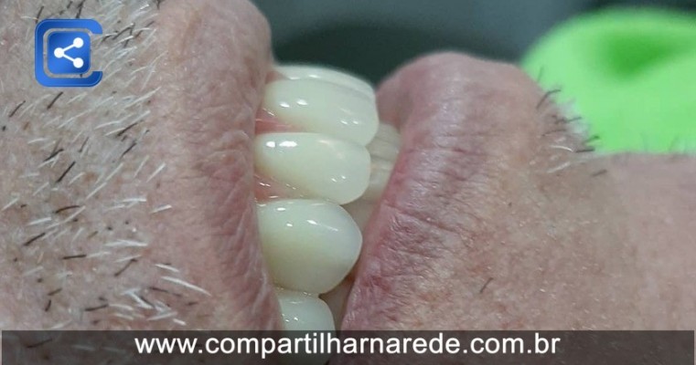 Tratamento Dentário Rápido em Salgueiro, PE Dr Edmar Cezar