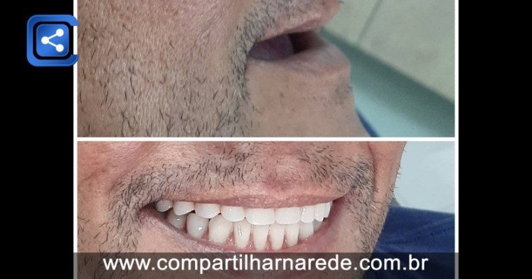 Preço do Implante Dentário em Salgueiro, PE Dr Edmar Cezar