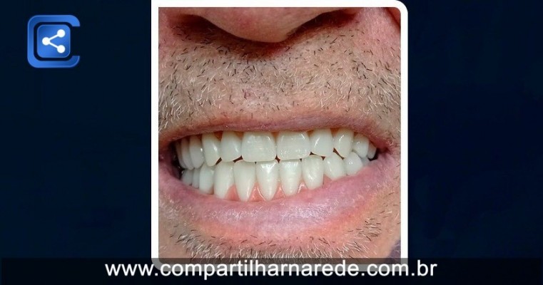 Quanto custa uma prótese Dentária Fixa em Salgueiro, PE Dr Edmar Cezar