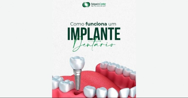 Implante dentário em Salgueiro Center - Dr Leandro