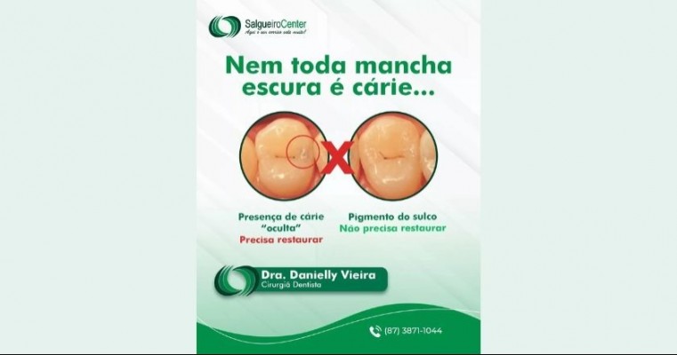 Nem toda mancha escura é sinônimo de cárie Salgueiro Center - Dr Leandro