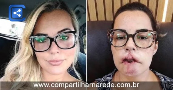 Mulher perde o lábio superior após realizar preenchimento com PMMA