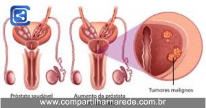 Câncer de Próstata: 10 Mil Pacientes Sem Acesso à Radioterapia Pelo SUS Todos os Anos