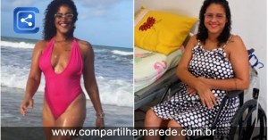 Jovem de 26 anos fica paraplégica após espremer furúnculo e quase morre: 'tentei tirar o pus'