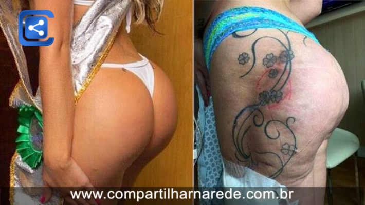 Imagens fortes do bumbum de Andressa Urach depois da cirurgia.