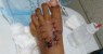 Criança de 11 anos tem pé quebrado após acidente com árvore no Parque Municipal de Petrolina