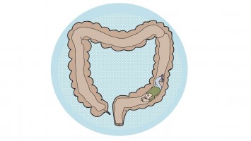 Alimentos "amigos do intestino" x vilões