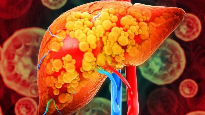 Como saber se estou com gordura no fígado? Hepatologista responde