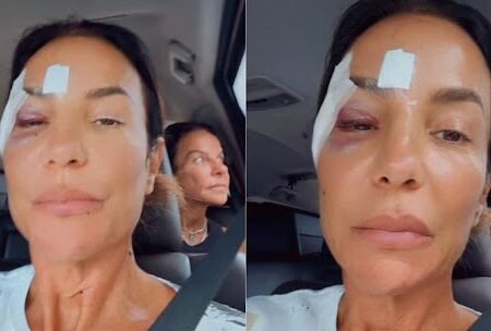 Ivete Sangalo recebe alta após desmaio, explica diagnóstico e faz piada com hematomas